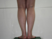 全身の脂肪吸引でキレイな体型に 30歳女性161㎝56㎏　6（ふくらはぎダウンタイム）