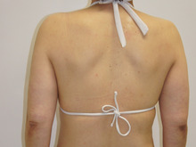 【53歳女性】 たるみのある女性の二の腕に脂肪吸引は効果があるか 2