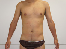 男性のベイザー脂肪吸引　腹部・腰部　1　【ダウンタイム】