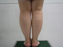 30歳女性のふくらはぎ・足首脂肪吸引2（ダウンタイム）
