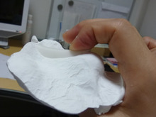 小鼻縮小手術後、とても厚い鼻プロテーゼ+鼻尖修正