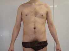 男性の全腹部腰部ベイザー脂肪吸引1（ダウンタイム）