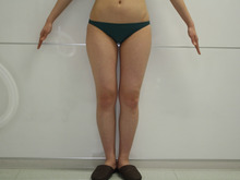 163㎝53㎏24歳 太ももとお尻膝回りの脂肪吸引1（スリムリフト）ダウンタイム
