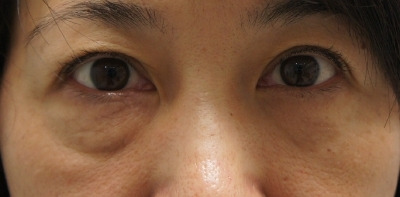 【52歳女性】目の下の切開によるタルミ取り 半年後