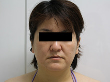 フェイスリフト写真の正しい見方　その3