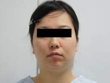 29歳女性。かなりふっくらしている状態からの頬・アゴベイザー1（ダウンタイム）