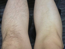 右脚だけ脱毛とは