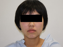 27歳女性　頬・アゴベイザー（バッカルファット除去後）1