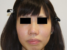 鼻翼縮小（小鼻縮小）の傷の様子（3か月）