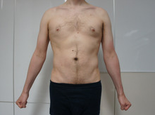 男性の全腹部腰部ベイザー脂肪吸引3（6か月）