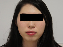 アゴのレディエッセ1.5ccで美人顔に　20歳くらい女性