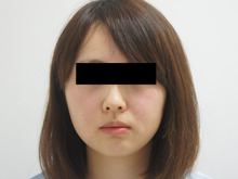 26歳女性 頬とアゴ下のベイザー脂肪吸引1　ダウンタイム1か月まで