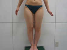 ２５歳女性の脚全体のベイザー脂肪吸引　