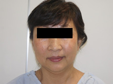 55歳女性　フェイスリフト+頬アゴ下脂肪吸引+ほうれい線脂注1（ダウンタイム）