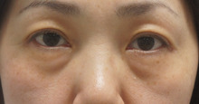 47歳目の下のたるみを皮膚切除なしで改善