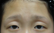 一重のせいで視界が悪い→年を取って見えてしまう18歳の埋没法