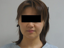 31歳女性 頬とアゴのベイザー脂肪吸引2　　3か月後