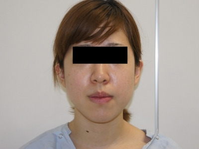 ２１歳 頬“だけ”VASER脂肪吸引　2　３か月目