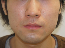 男性の小顔注射　2回ですっきりしました(≡^∇^≡)