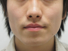 【著効・必見】男性の小顔注射。　肉食系男前に