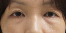 46歳女性目の下のたるみとり（脂肪除去と脂肪注入同時に）