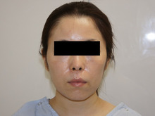 35歳女性頬・アゴ下ベイザー　1ダウンタイム（内出血強め）