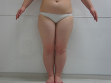 151㎝70㎏でとても太い太ももを右左の2回に分けて脂肪吸引2（術後1年）