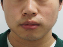 【またしても著効・必見】男性の小顔注射　　