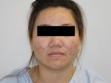 22歳女性の頬とアゴのVASER(ベイザー）脂肪吸引1　ダウンタイム