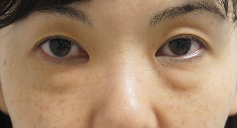 39歳女性目の下のクマ　切らずに改善（経結膜脱脂術+脂肪注入）
