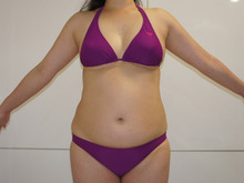 42歳164㎝70㎏　腹部・腰部・下背部のベイザー脂肪吸引 1　ダウンタイム
