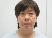 61歳女性　フェイスリフト+頬アゴ下脂肪吸引+中顔面・ほうれい線脂肪注入　1 ダウンタイム