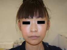 アゴと鼻にレディエッセ1本で美人顔に