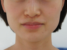 小顔注射　著効例です。