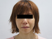 【44歳女性他院フェイスリフト後】　ミントリフトで大満足(≡^∇^≡)　2　3か月後