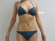 160㎝45㎏（やせ型）35歳女性腹部・腰部（上臀部）のベイザー脂肪吸引　2　半年後