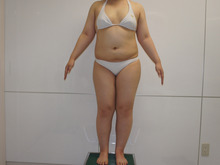 151㎝69ｋｇ24歳　片脚ずつVASER脂肪吸引　1ダウンタイム