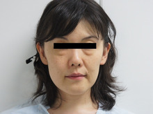 39歳女性のミントリフト　術前-二日後-2か月後