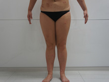 40歳162㎝58㎏太もも・お尻膝・周りのベイザー脂肪吸引　2