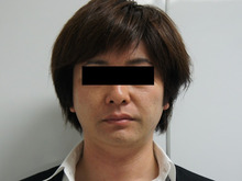 38歳男性　ミントリフトにて若返り1　ダウンタイム
