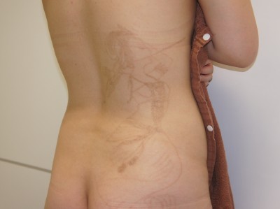 大きな天女のTATTOO・入れ墨・刺青をレーザー除去6
