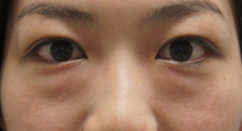 目の下のクマがもったいない30歳女性　ダウンタイムほぼなく大改善ヾ(＠^▽^＠)ﾉ