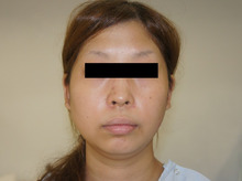 27歳女性頬とアゴ下のVASER脂肪吸引（ベイザー）で見違える雰囲気に