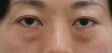 35歳女性 涙袋を消失させる目袋+中顔面痩せを一気に改善