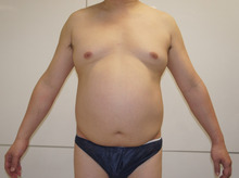 43歳男性メタボ体型・女性化乳房のベイザー脂肪吸引2　1か月目