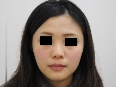 太くなりにくいヒアルロン酸　エレベスですっきりと細い鼻筋を