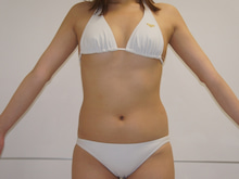 VASERによるおなか回りの脂肪吸引【27歳女性】3　1年後
