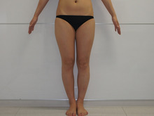 31歳女性　157㎝49㎏太もも・お尻・膝周りベイザー脂肪吸引　美脚効果　1