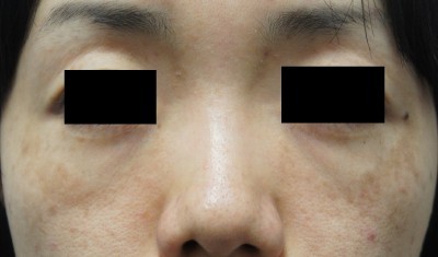 肝斑の治療にレーザートーニング・・・本当に効くんです(o^-‘)b　3回施術後