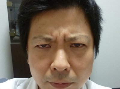 【ネタ注意☆(ゝω・)v】眉間ボトックスの威力とは